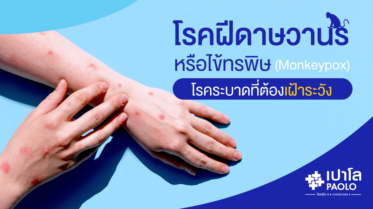 โรคฝีดาษลิงหรือไข้ทรพิษ (Smallpox) โรคระบาดที่ต้องเฝ้าระวัง
